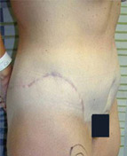 Bodylift