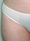 Liposuction - Post Op