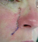 Skin Tumour - Post Op