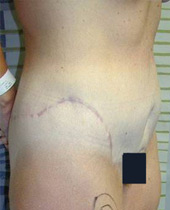 Body lift - Post Op