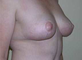 Post Breast lift/ Mastopexy