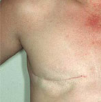 TRAM Breast Reconstruction - Pre Op