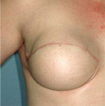 TRAM Breast Reconstruction - Post  Op