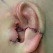after ear reconstruction