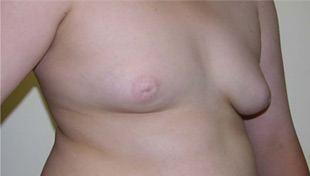 Male breast reduction (Gynaecomastia)