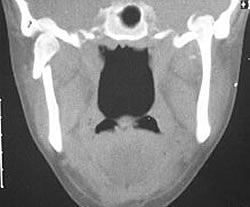 Intracranial condyle penetration