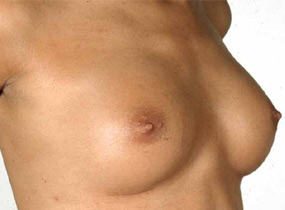 Breast implants - Post op