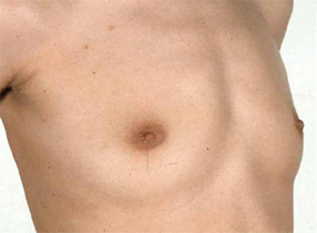 Breast implants - Pre op