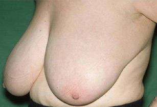 Breast reduction - Pre Op